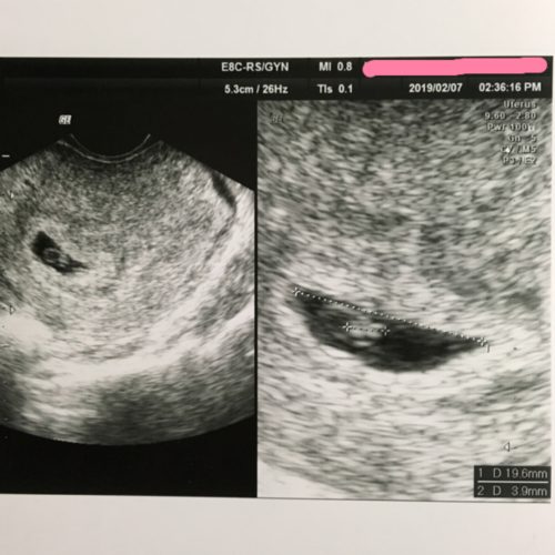胎嚢 確認 後 流産